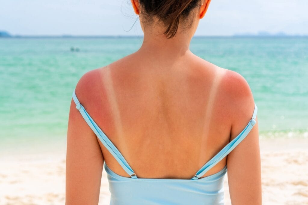 Sol, solskoldning, skade, sommer - welltica.dk - Vejen til et bedre liv