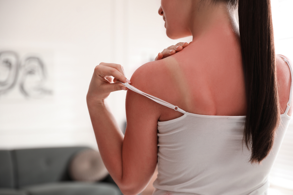 Woman,With,Sunburned,Skin,At,Home,,Closeup - welltica.dk - Vejen til et bedre liv