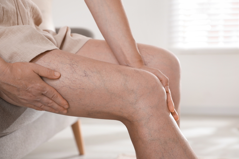 Woman,Suffering,From,Varicose,Veins,On,Sofa,Indoors,,Closeup - welltica.dk - Vejen til et bedre liv