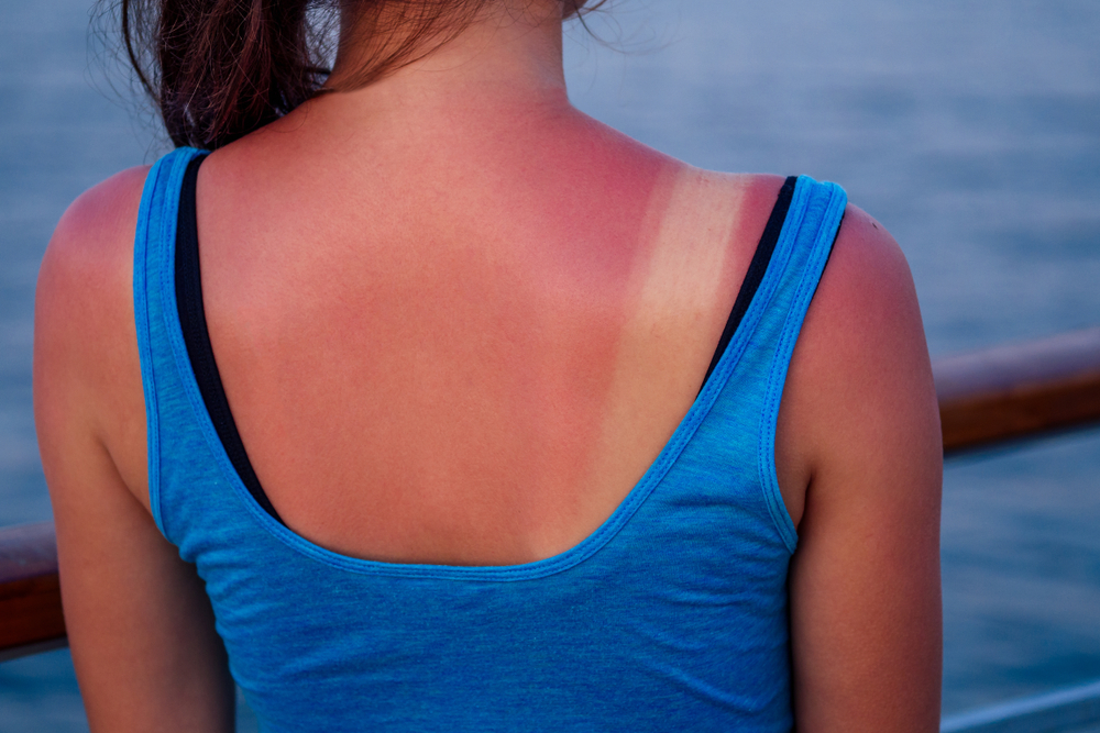 BurntFemaleSkinInTheSunClose-upInABlue - welltica.dk - Vejen til et bedre liv