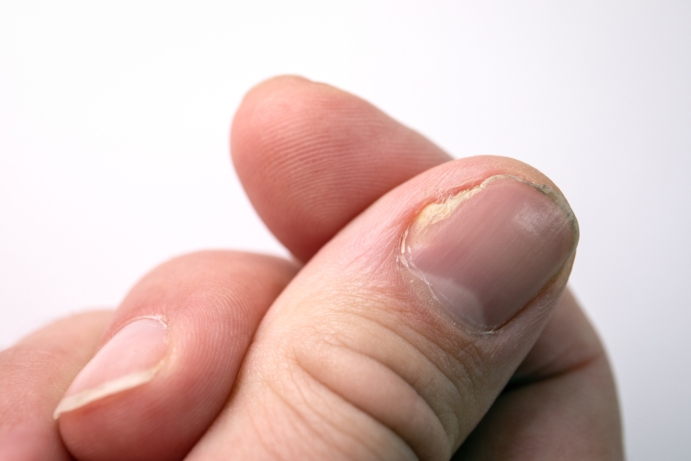 CloseUpOfNailFungusInfectionOnTheThumbFinger - welltica.dk - Vejen til et bedre liv