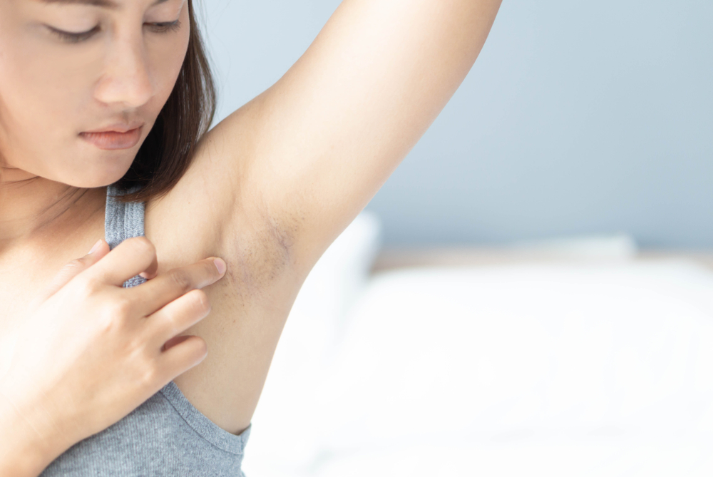 Women,Problem,Black,Armpit,Lying,On,White,Bed,Background,For - welltica.dk - Vejen til et bedre liv