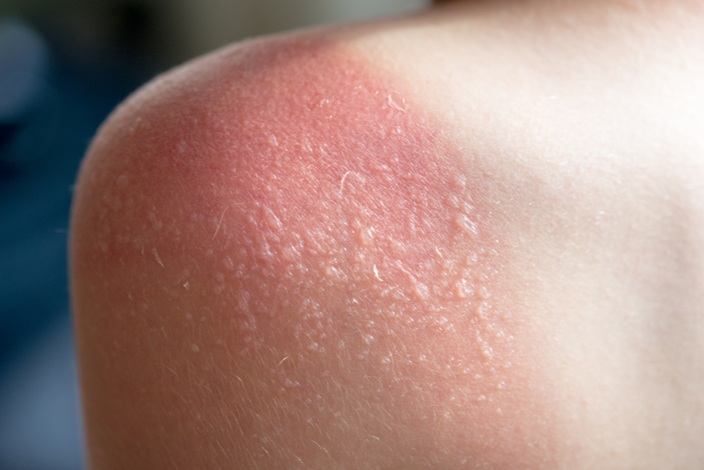 SkinCareConceptGuyGotSunburnAndGotTanLines - welltica.dk - Vejen til et bedre liv
