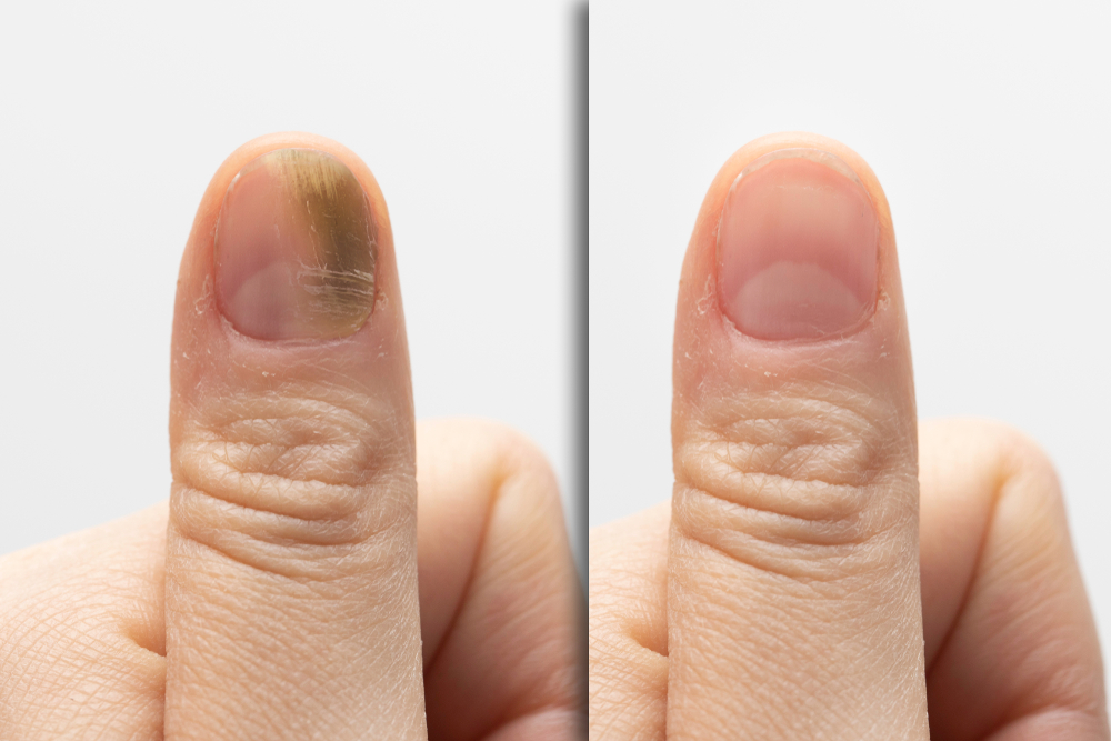 BeforeAndAfterSuccessfulTreatmentForAFungalInfectionOn - welltica.dk - Vejen til et bedre liv