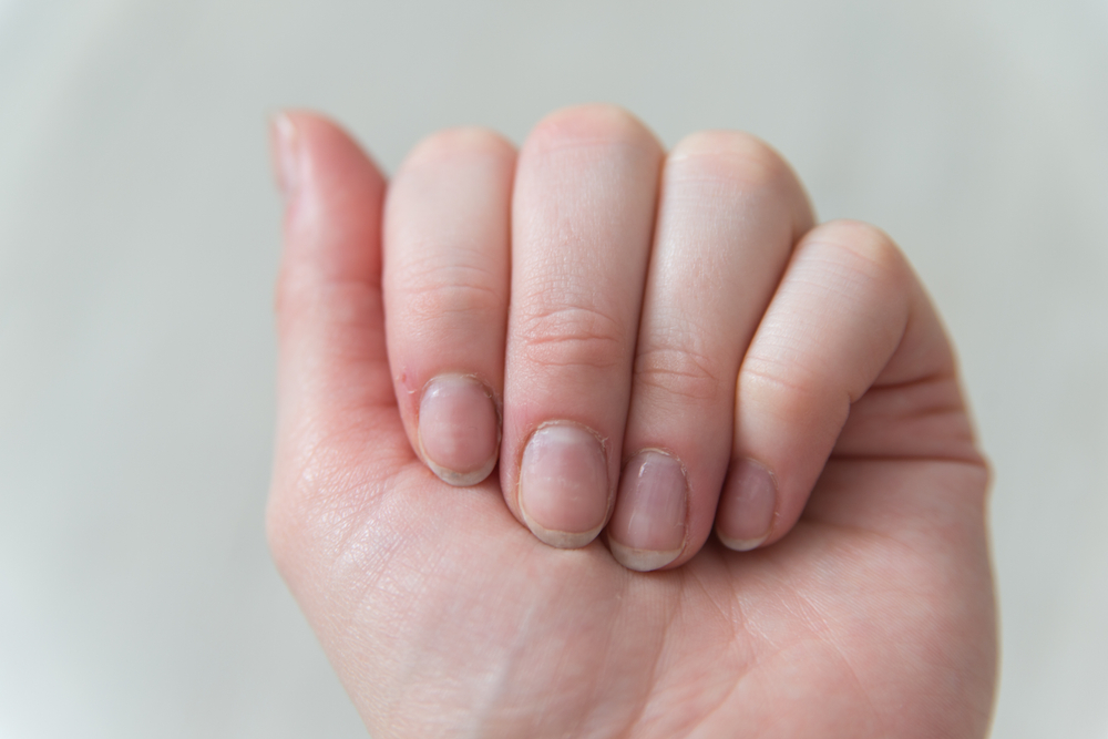 CloseUpFemaleNailsWithoutManicureOvergrownCuticleFingernailsAnd - welltica.dk - Vejen til et bedre liv