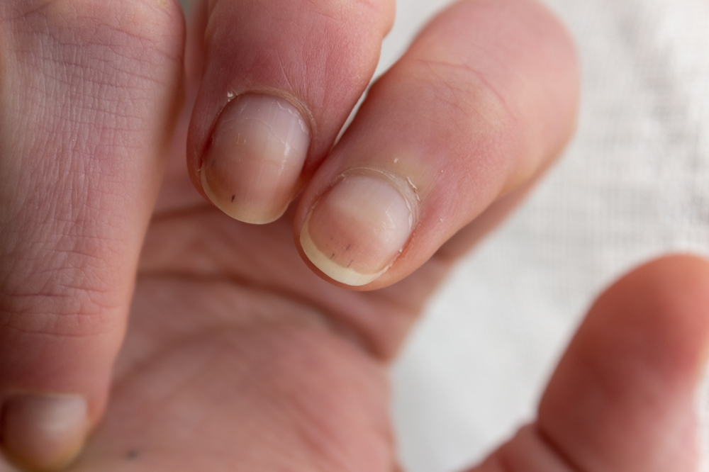 NailWithDarkSpotsYellowishAndDryNailsWithSickness - welltica.dk - Vejen til et bedre liv