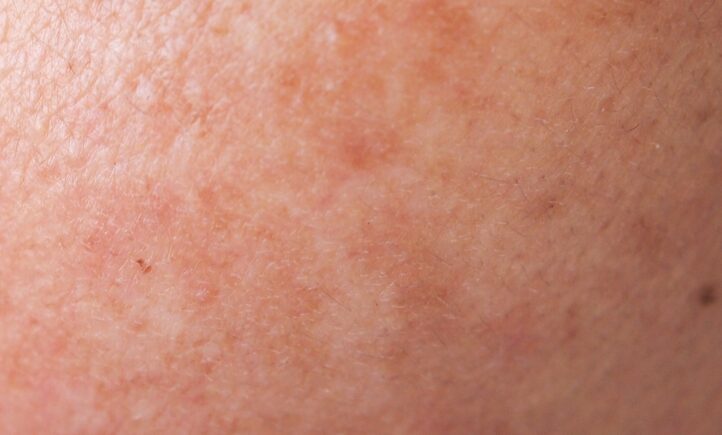 ProblemSkincareAndHealthConceptcloseupWrinklesmelasmadarkSpotsfrecklesdrySkinpigmentOnAsian - welltica.dk - Vejen til et bedre liv