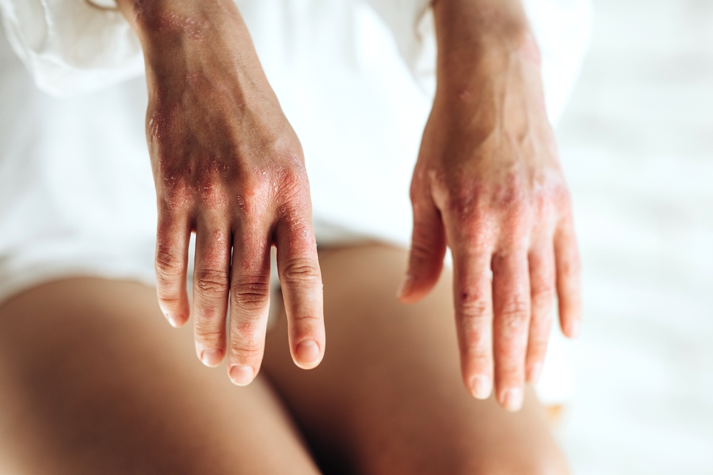 PsoriasisASkinDiseaseInAYoungWoman - welltica.dk - Vejen til et bedre liv