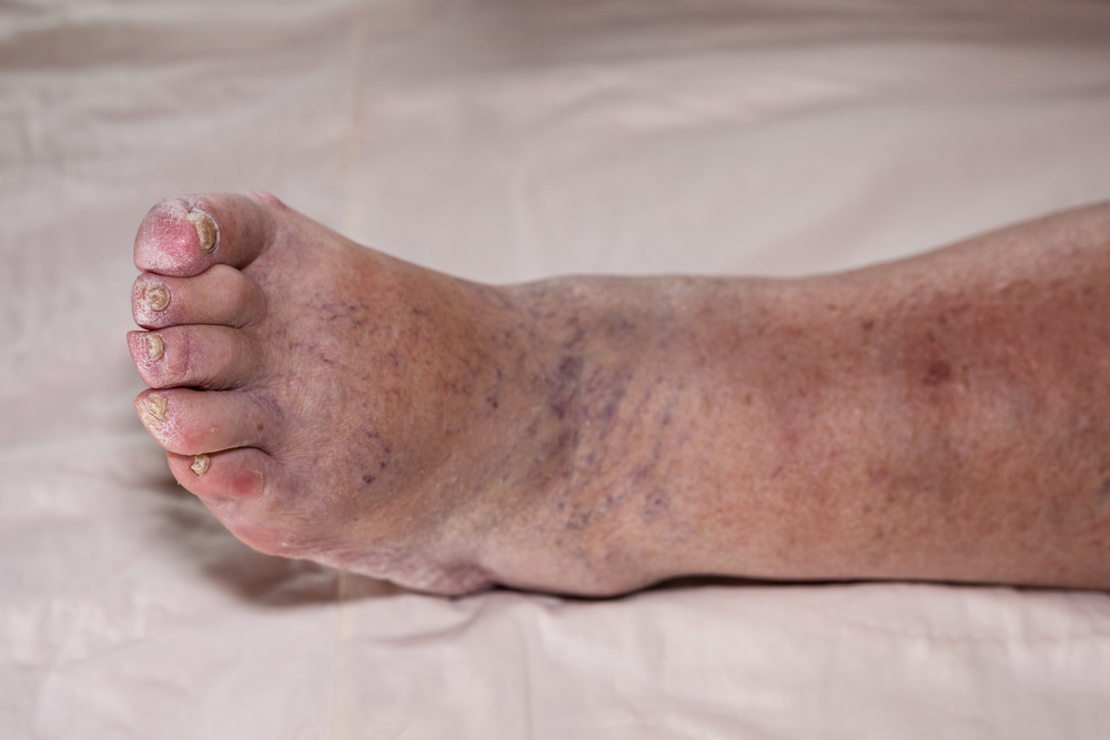DetailOfIllSeniorFemaleSwollenLegWithDamagedToes - welltica.dk - Vejen til et bedre liv