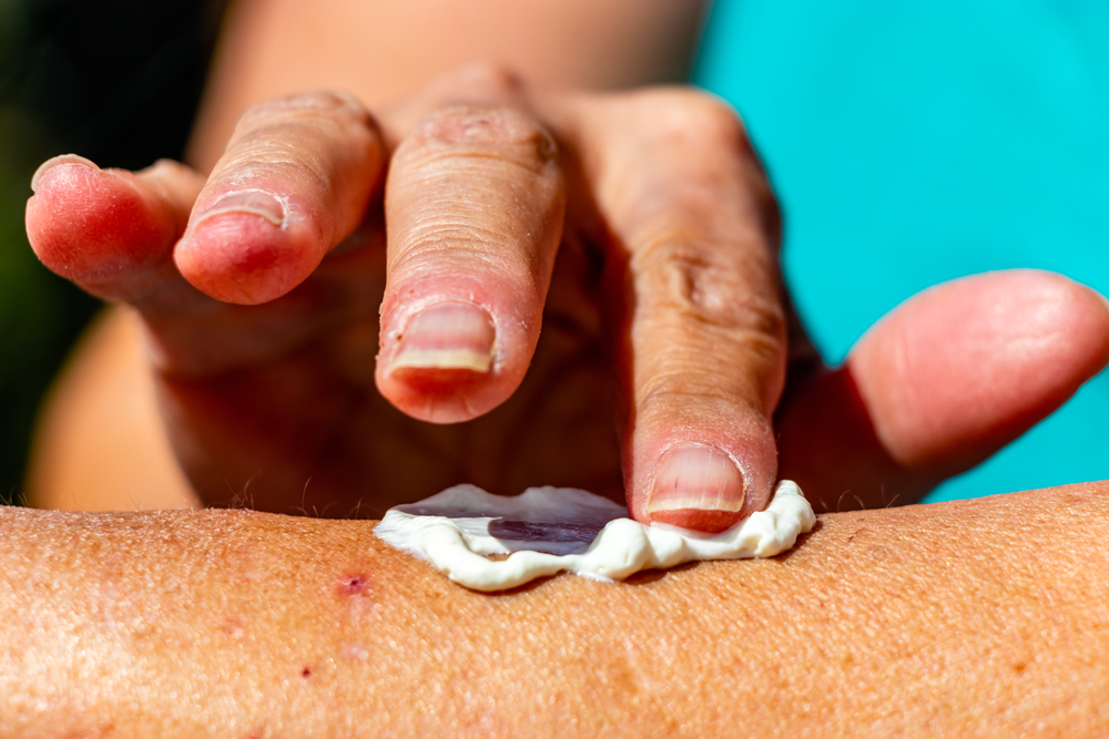 ApplyingSunScreenToAnArmCalgaryAlbertaCanada - welltica.dk - Vejen til et bedre liv