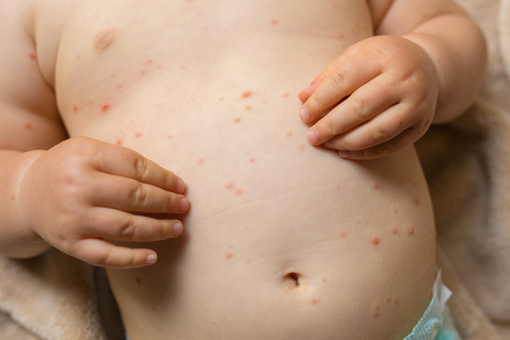BabyWithRedSpotsOfChickenpox - welltica.dk - Vejen til et bedre liv
