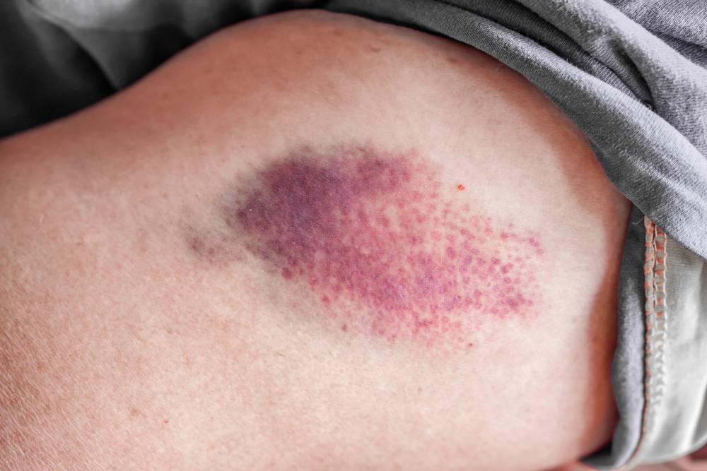 LargeInjectionBruisedOnWomanArmCloseup - welltica.dk - Vejen til et bedre liv