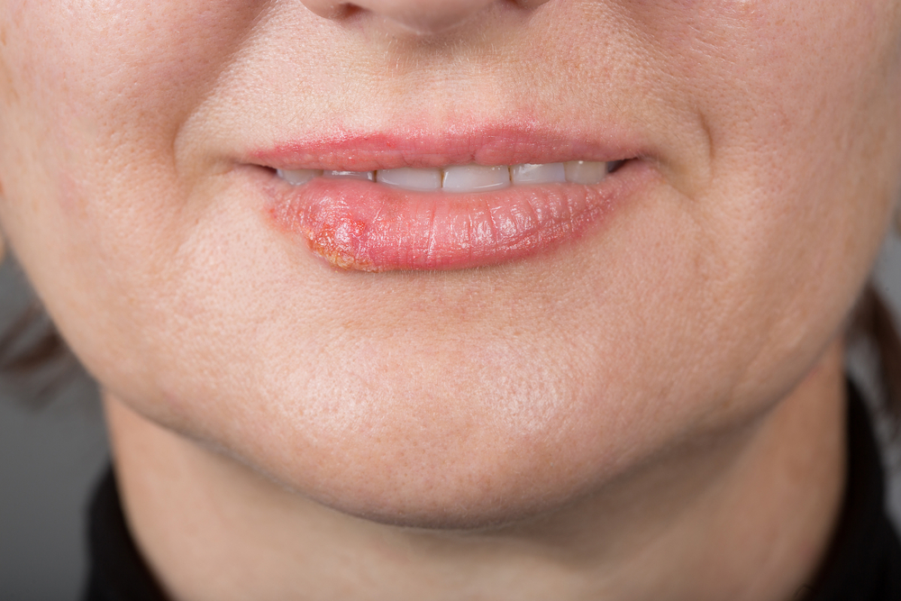 LipInfectionWithTheHerpesVirus - welltica.dk - Vejen til et bedre liv