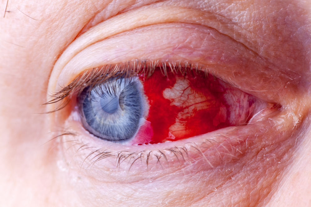 BloodshotEyeClose-upMacroImageOfAVeryRedBloody - welltica.dk - Vejen til et bedre liv