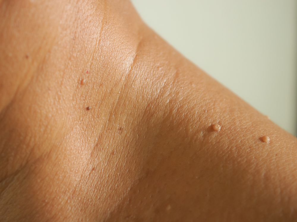 Close-upTheSkinTagsOnNeckManSkin - welltica.dk - Vejen til et bedre liv
