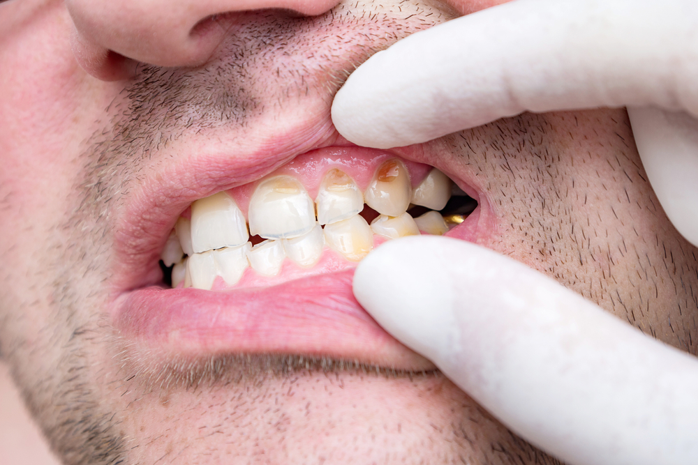 BadTeethOfAMiddle-agedManChippedAndCrackedTooth - welltica.dk - Vejen til et bedre liv