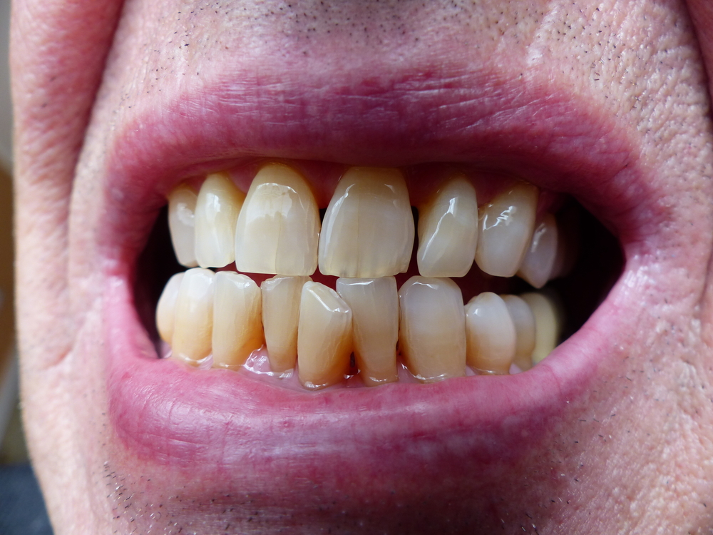 Well-preservedTeethOfA70Year-oldManInGermany - welltica.dk - Vejen til et bedre liv
