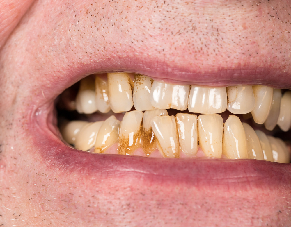 CloseUpMacroOfTeethOfPatientWithRecedingGums - welltica.dk - Vejen til et bedre liv
