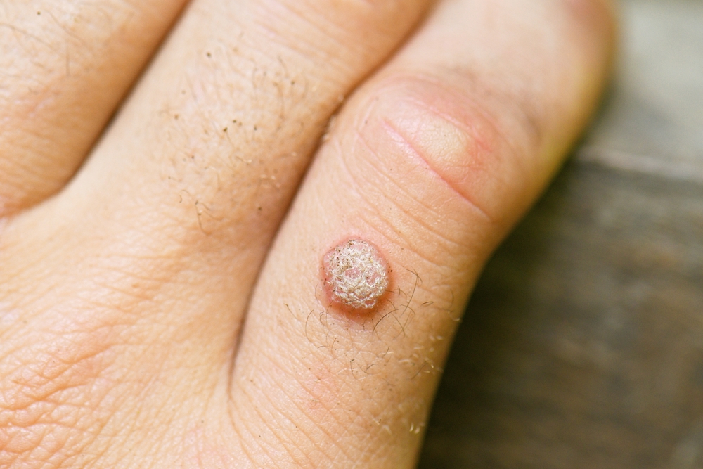 WartOnTheHandFinger - welltica.dk - Vejen til et bedre liv