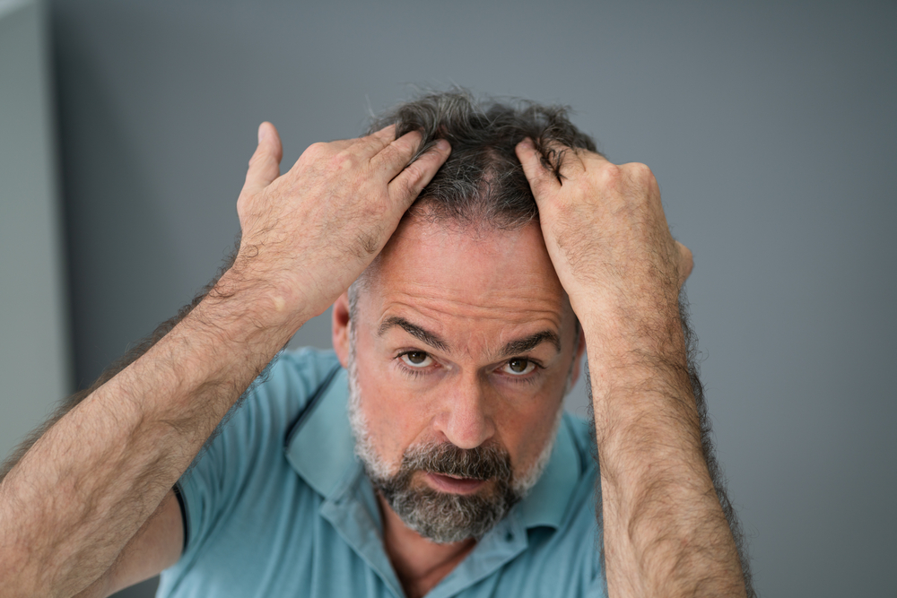 ManCheckingHisHairLossAndDandruff - welltica.dk - Vejen til et bedre liv
