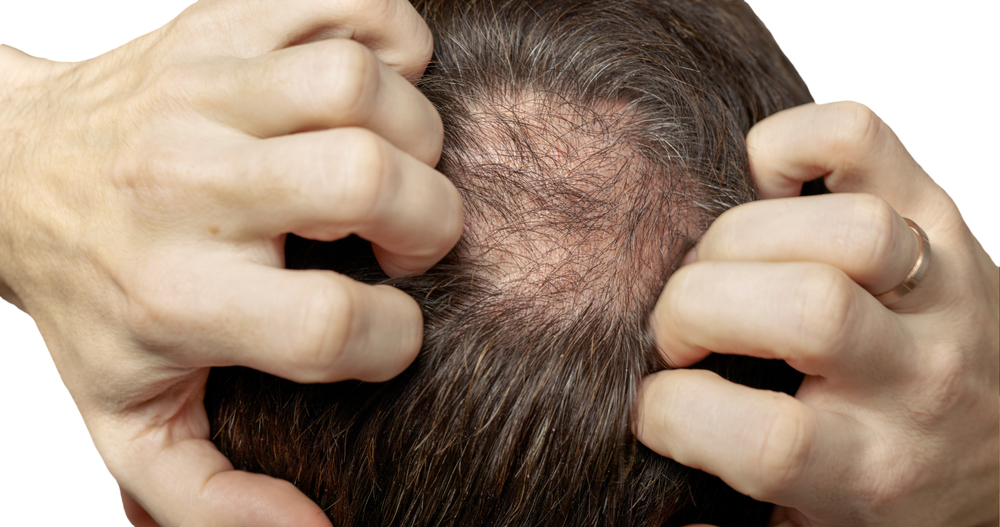 ManWithHairLossProblemsCloseupIsolatedAlopeciaBaldingHairs - welltica.dk - Vejen til et bedre liv