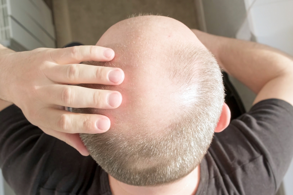 BaldnessManConcernedAboutHairLossMaleHeadWithBald - welltica.dk - Vejen til et bedre liv