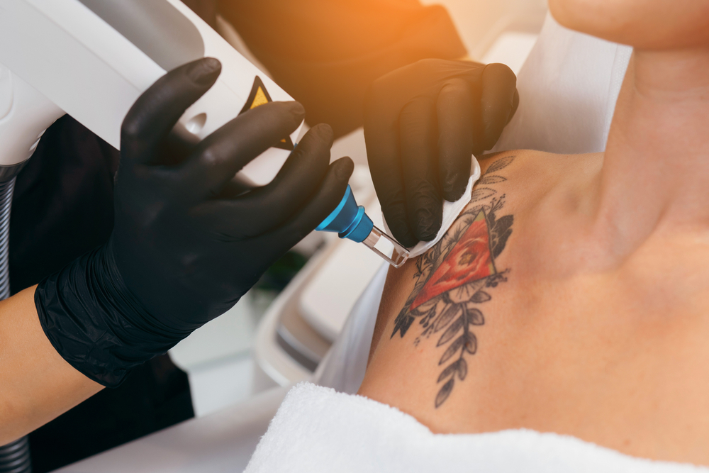 LaserTattooRemovalFromShoulder - welltica.dk - Vejen til et bedre liv